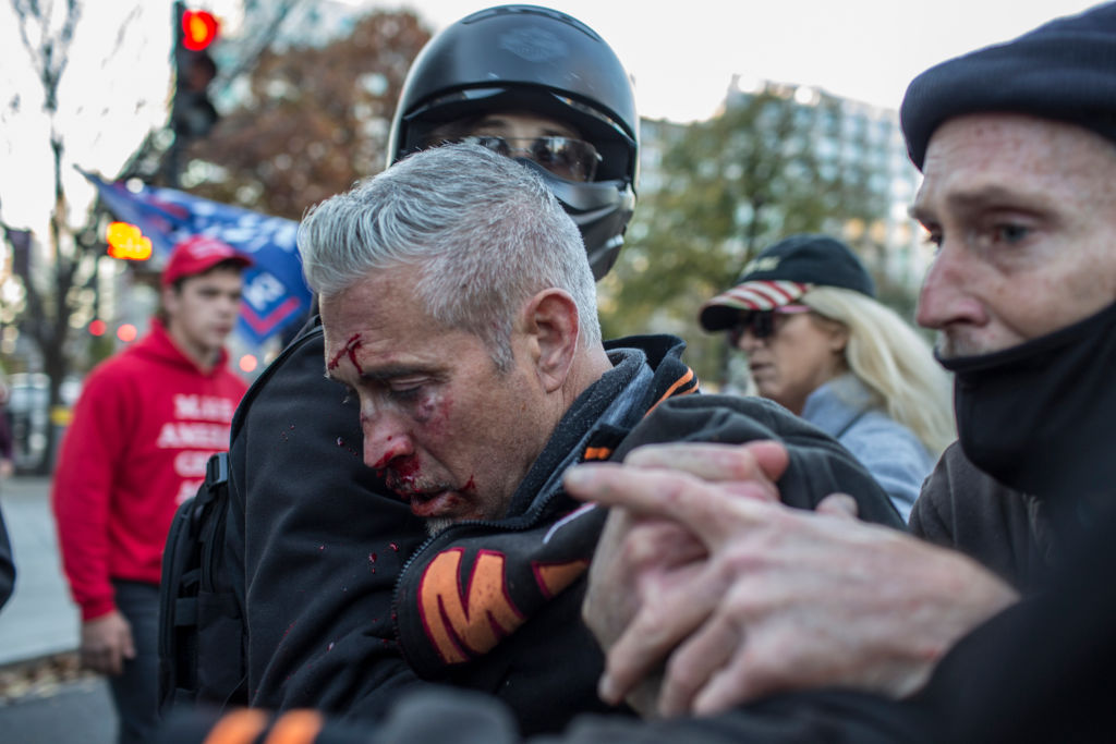 A supporter of Donald Trump is injured by anti-Trump...