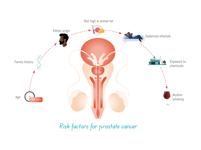 Risk factors for prostate cancer highlighted in medical diagram
